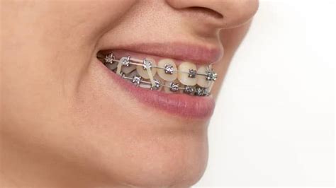 white rubber bands for braces